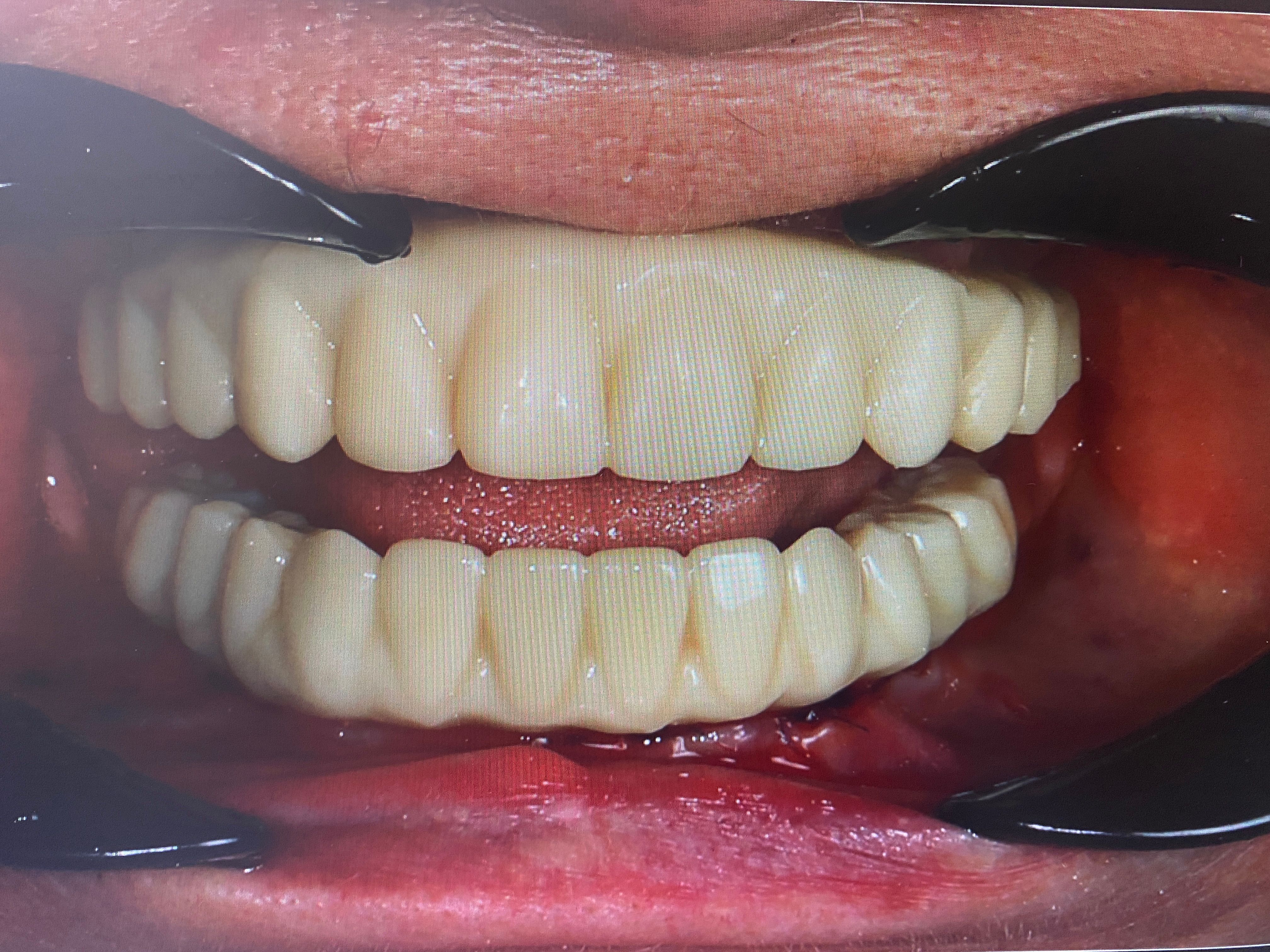 Результат после лечения: восстановление улыбки на временных протезах