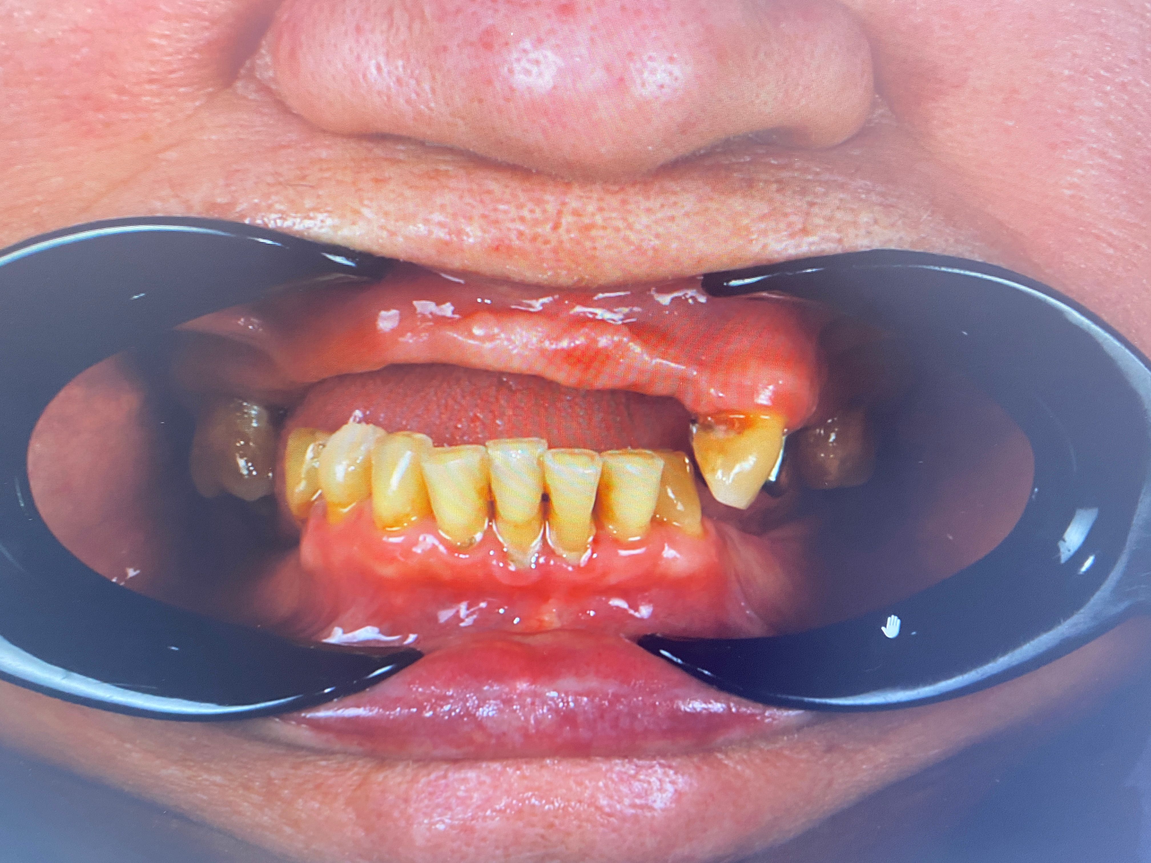 Состояние до лечения: выраженный дефицит зубов