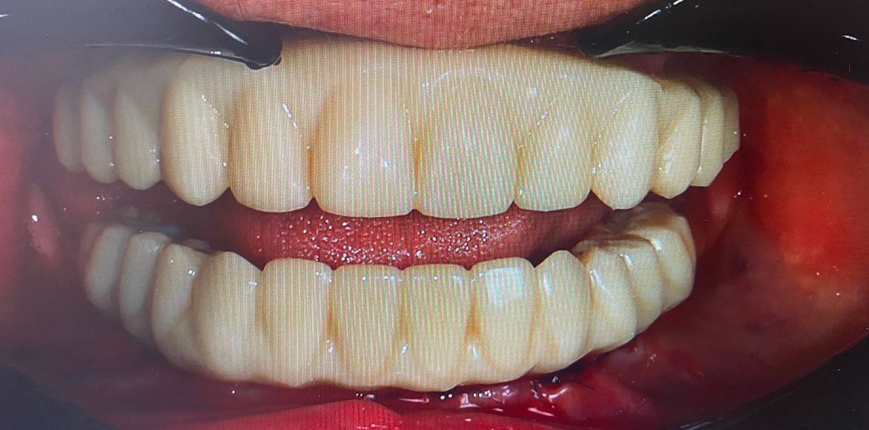 Результат после лечения: восстановление улыбки на временных протезах