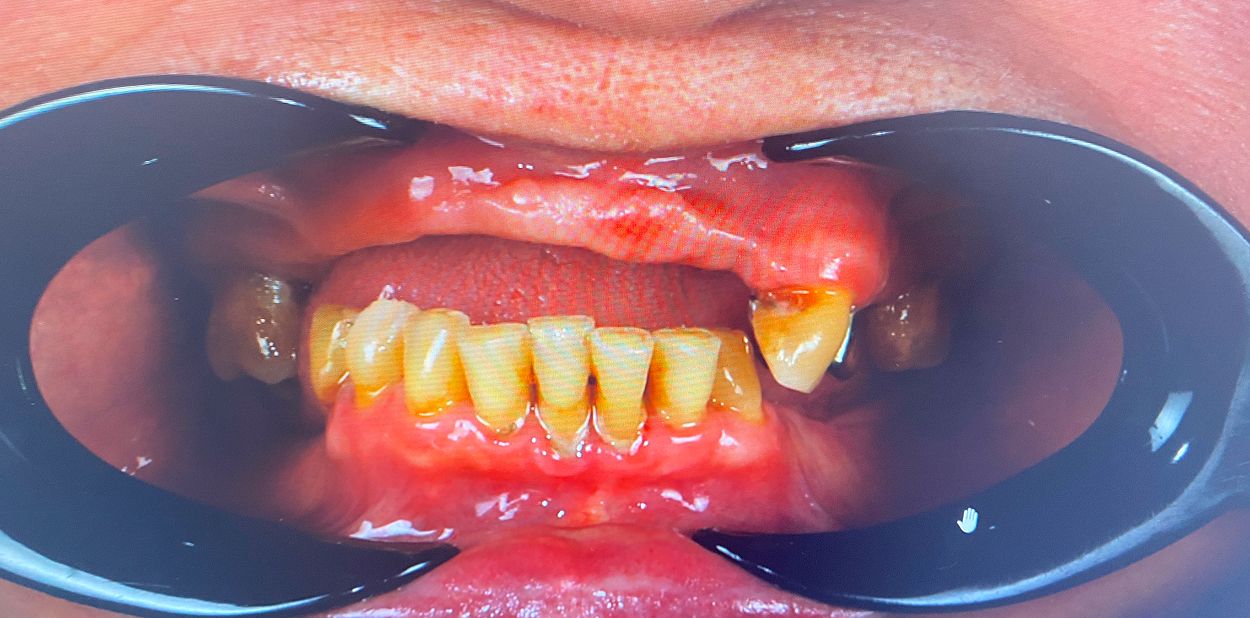 Состояние до лечения: выраженный дефицит зубов