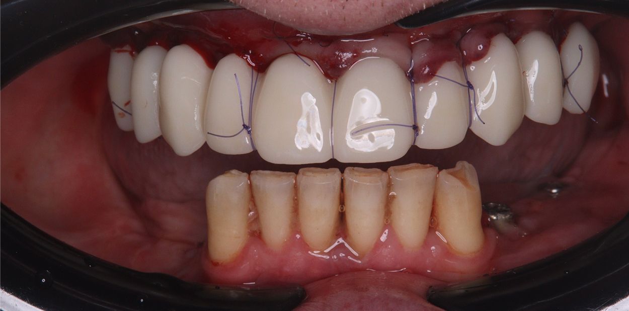 После лечения All-on-4 на верхней челюсти (кейс 1)