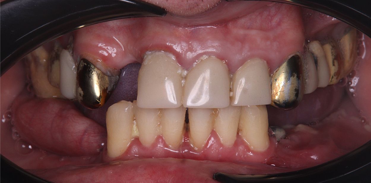 До лечения All-on-4 на верхней челюсти (кейс 1)