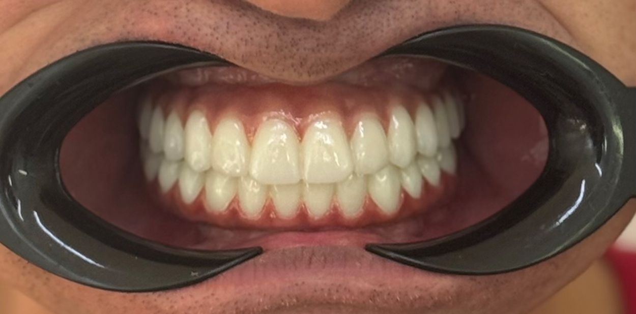После лечения All-on-6 на верхней и нижней челюсти (кейс 1)