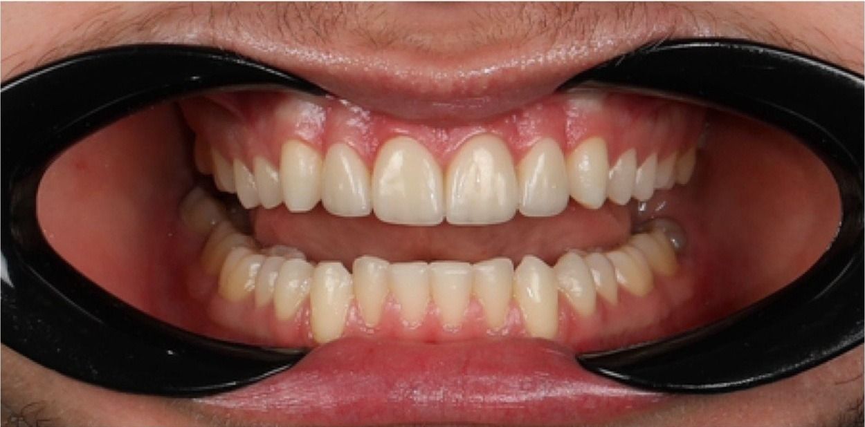 После установки виниров 12–22 (кейс 1)