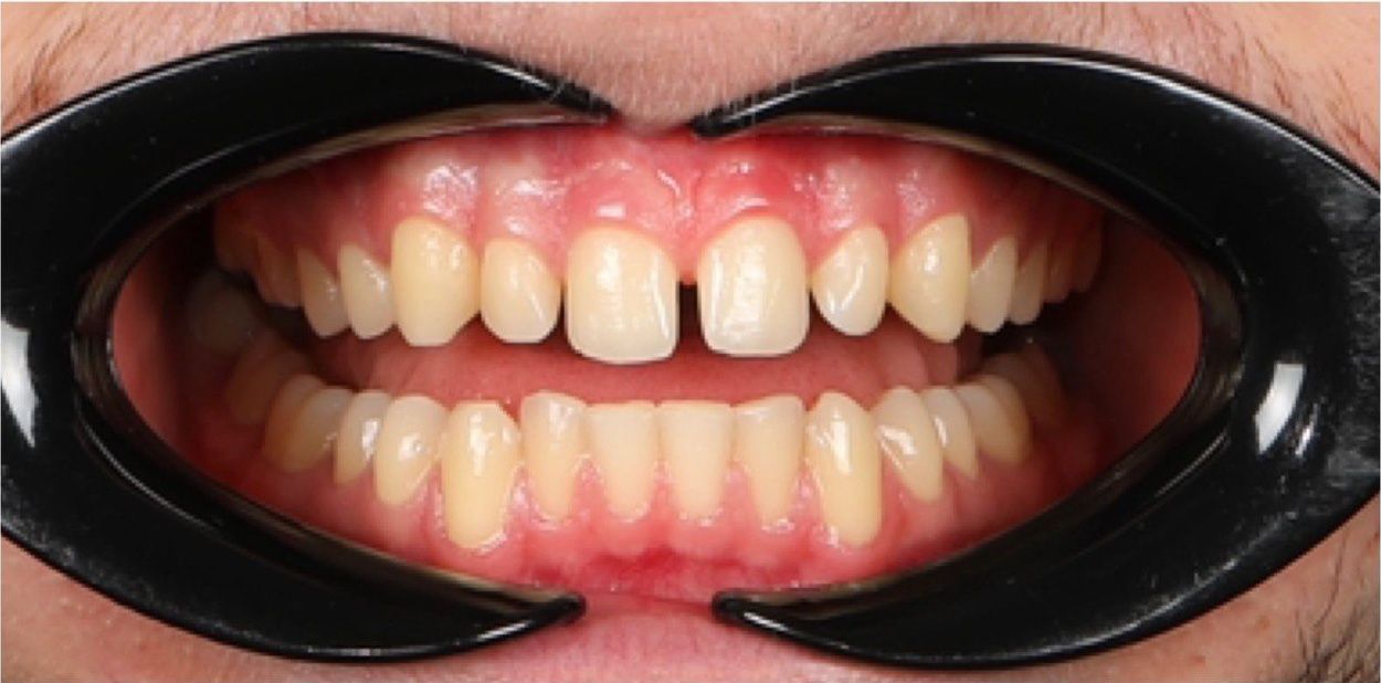 До установки виниров 12–22 (кейс 1)