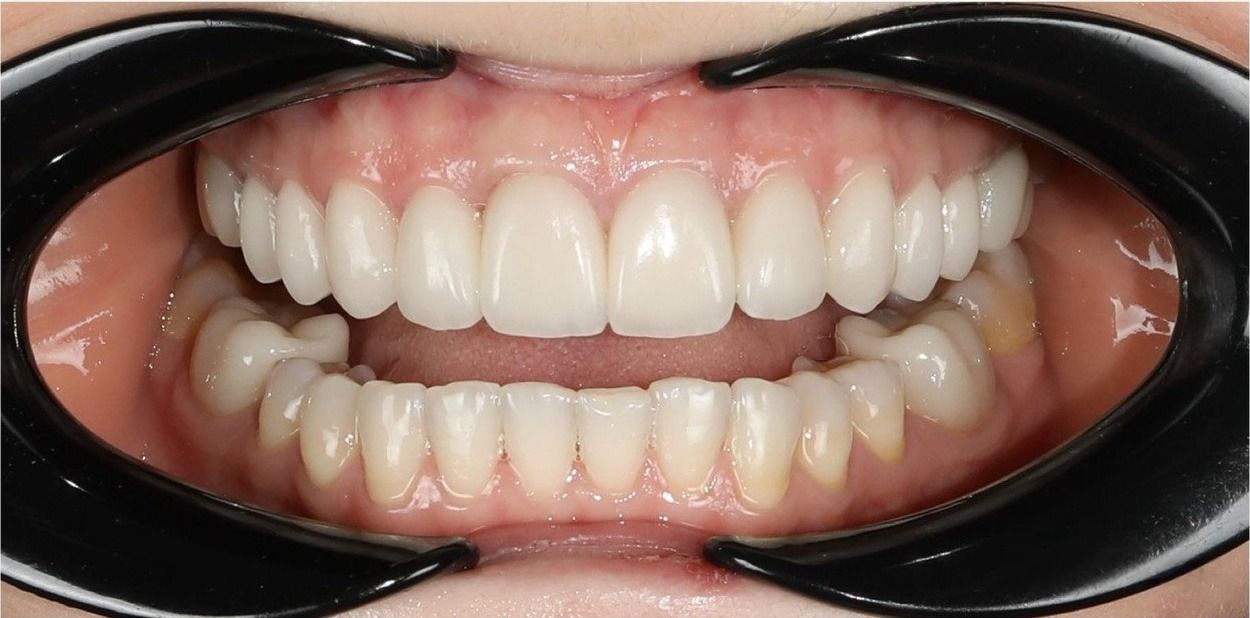 После установки виниров 12–22 (кейс 2)