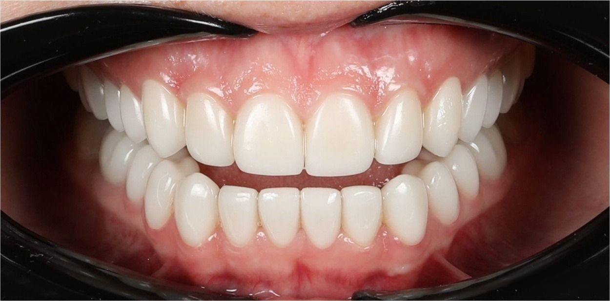 После установки виниров 12–22 (кейс 3)