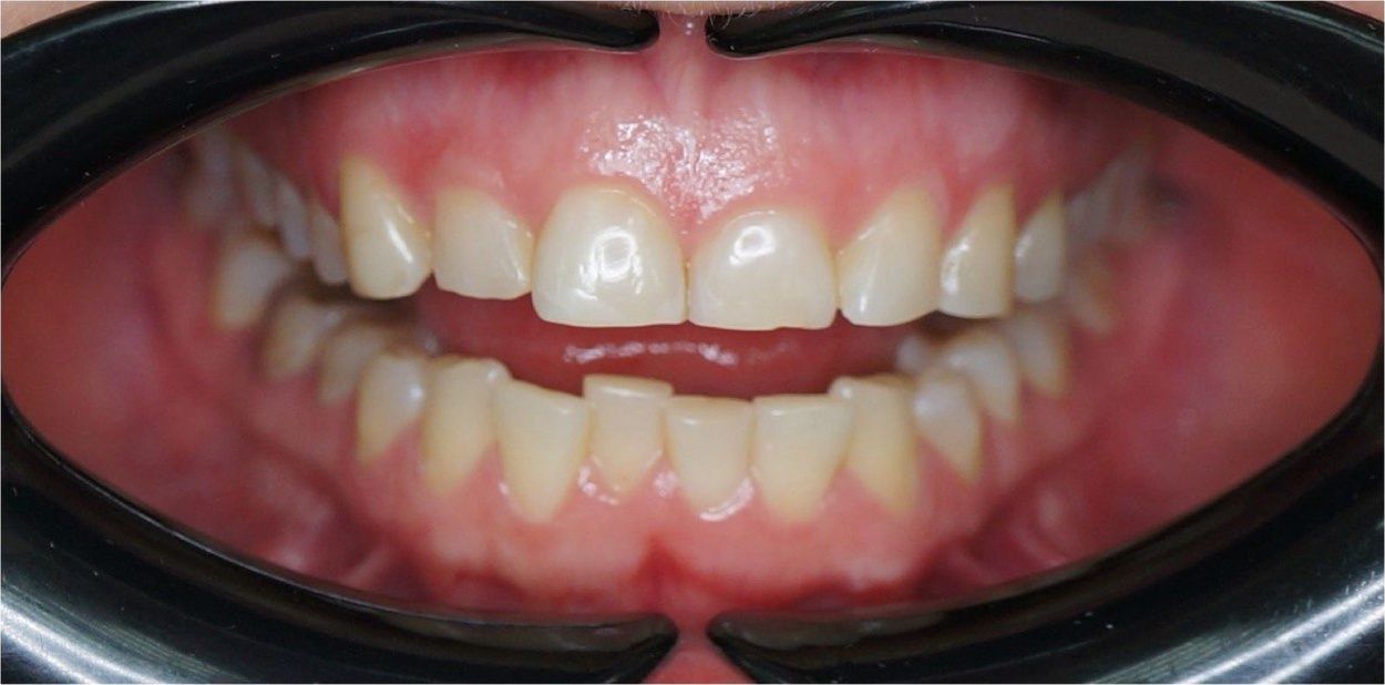 До установки виниров 12–22 (кейс 3)