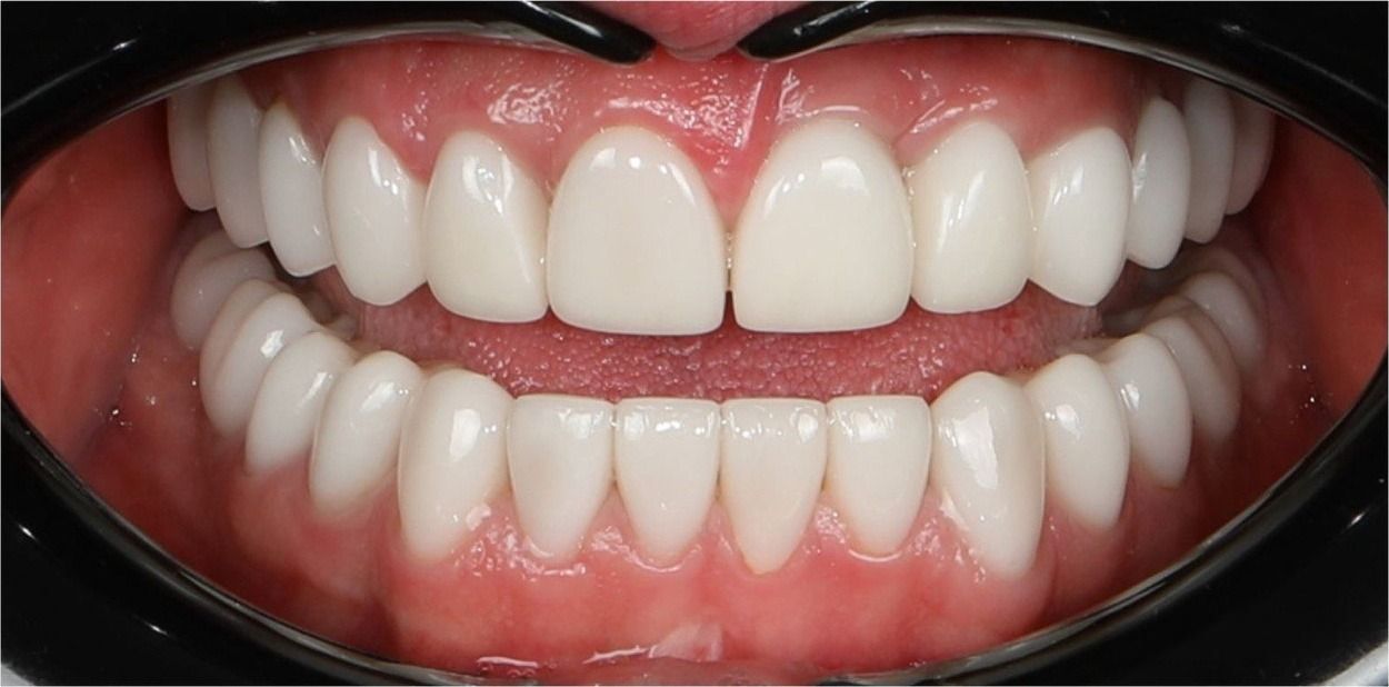 После тотальной работы винирами