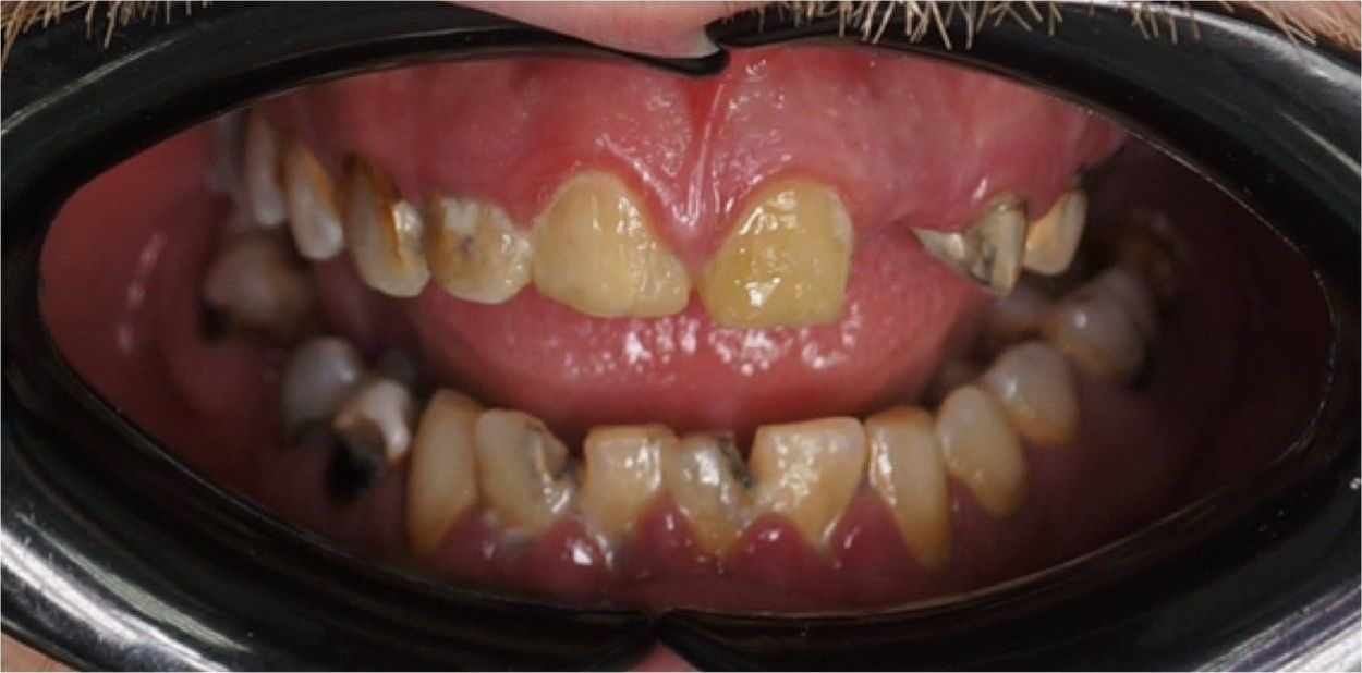 До тотальной работы винирами