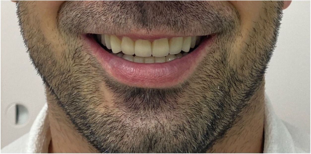 Улыбка пациента №1 после лечения