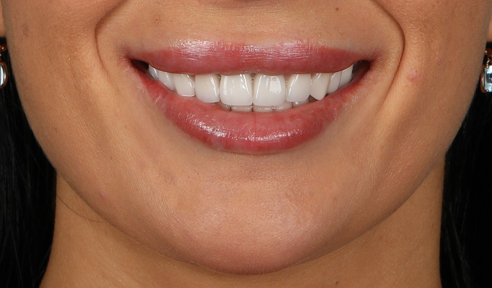 Улыбка пациента №4 после лечения