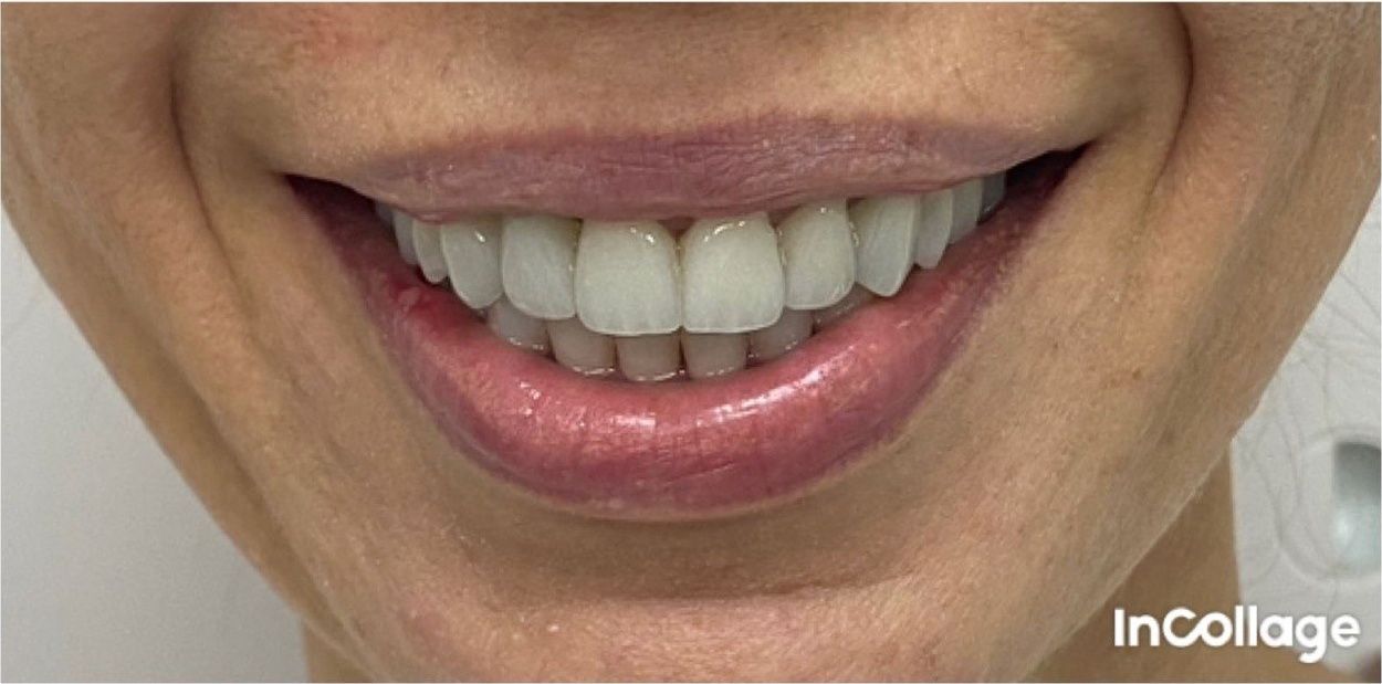Улыбка пациента №1 после лечения