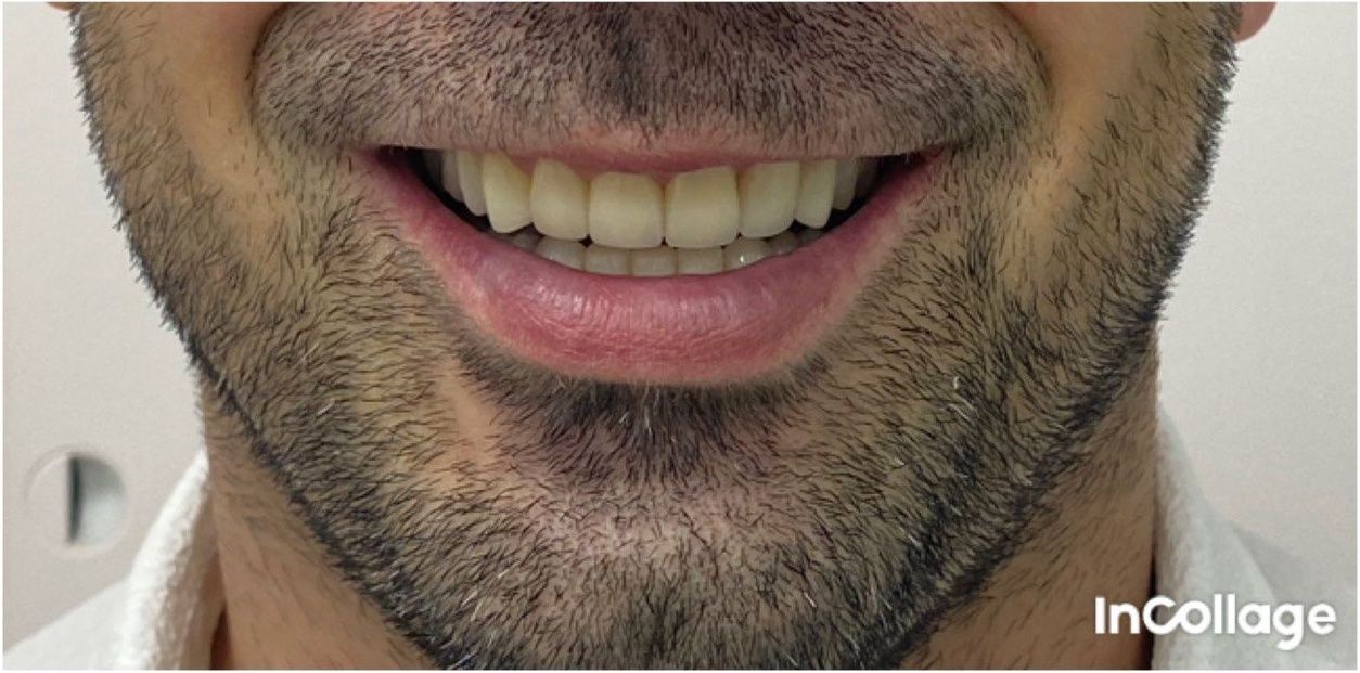 Улыбка пациента №2 после лечения