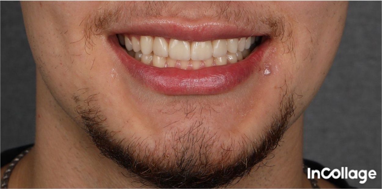 Улыбка пациента №3 после лечения