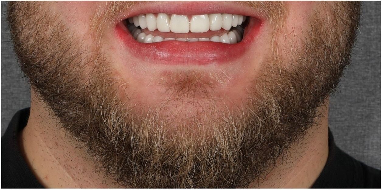 Улыбка пациента №3 после лечения