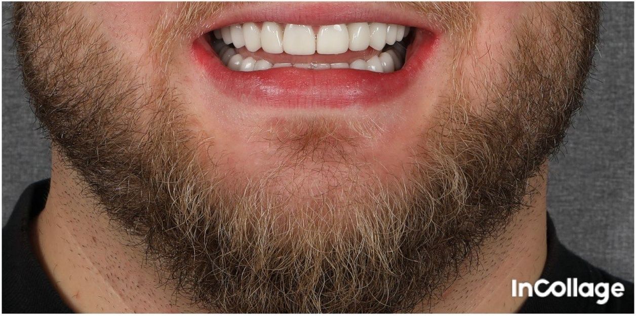 Улыбка пациента №4 после лечения