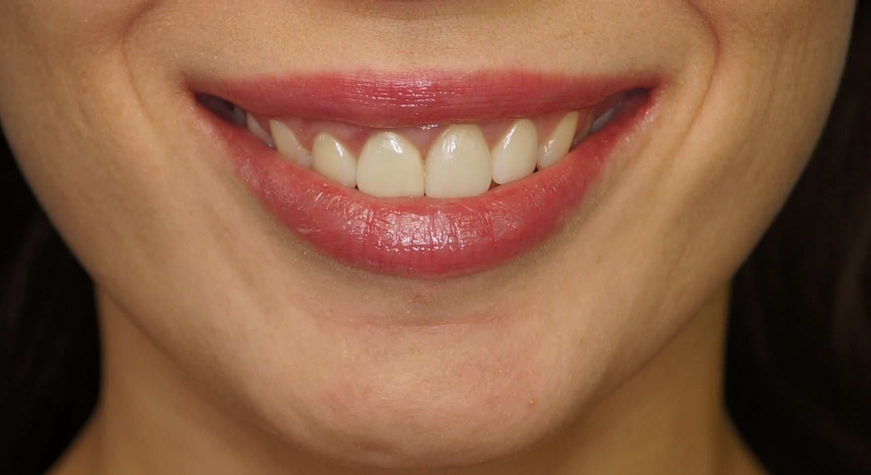 Улыбка пациента №5 после лечения