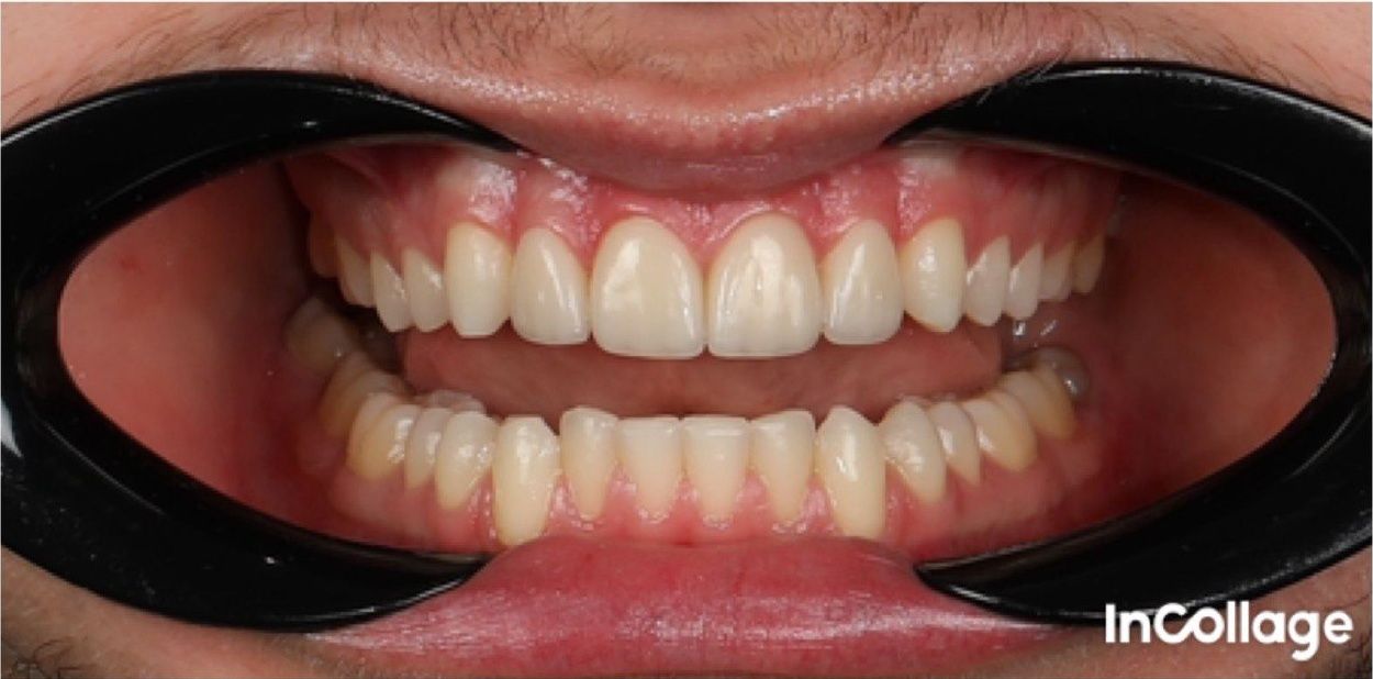 После установки виниров 12–22 (кейс 1)