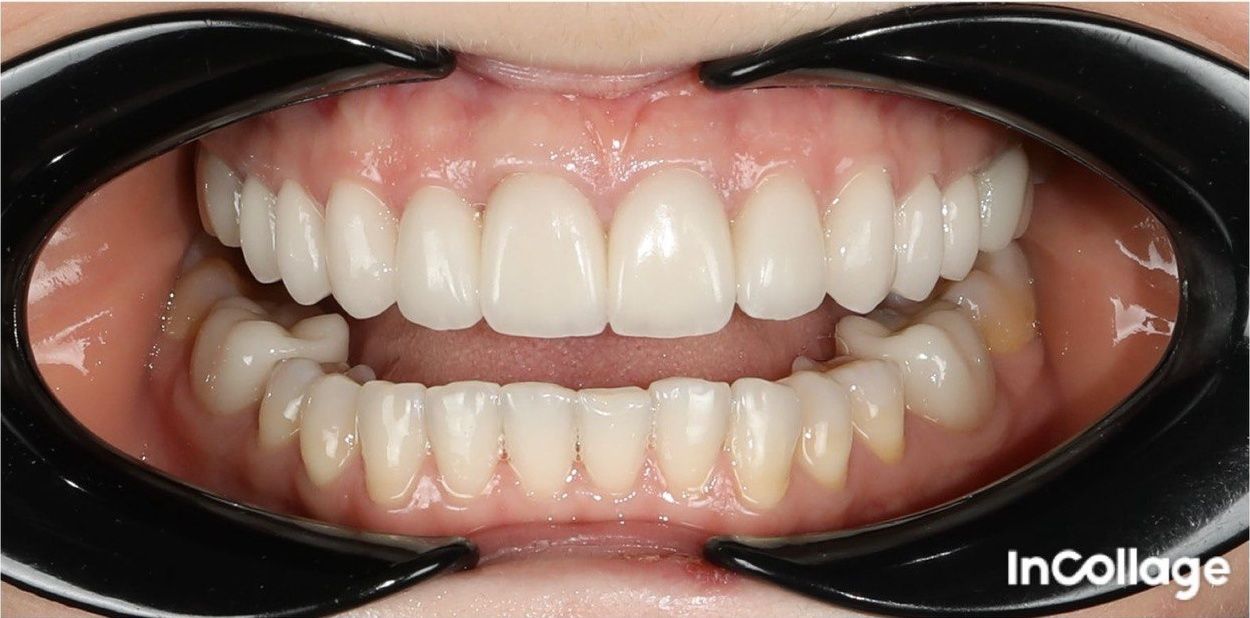 После установки виниров 12–22 (кейс 2)