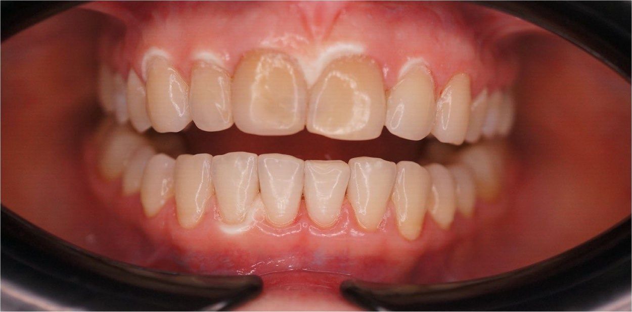 До установки виниров 12–22 (кейс 2)