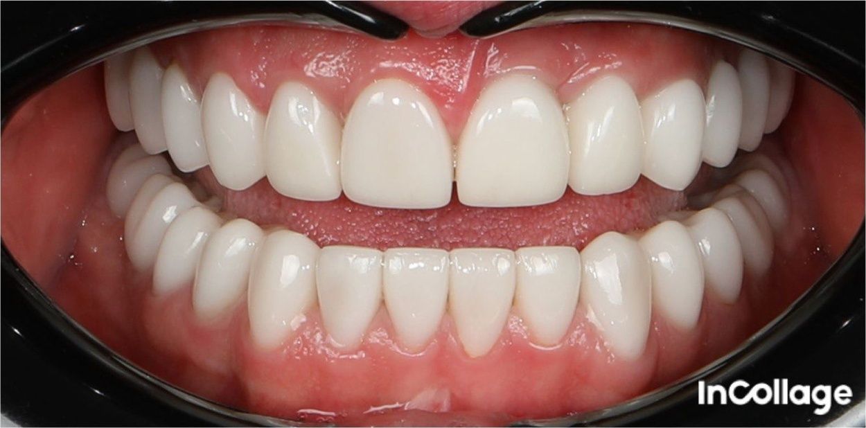 После тотальной работы винирами